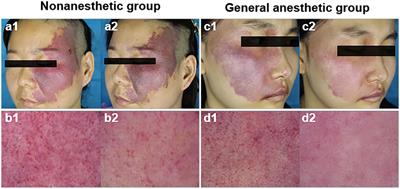 Hemoporfin-mediated photodynamic therapy with general anesthesia showed superior efficacy in the treatment of port-wine stains: a retrospective evaluation